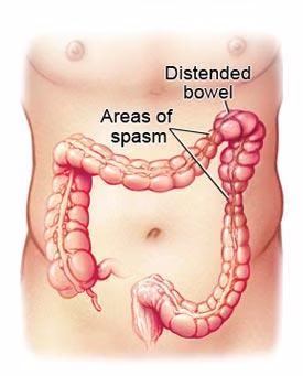 Foto dikke darm spasme, van de Osteopraktijk in Amsterdam, behandeling van bewegingsbeperkingen van botten, spieren, bloedvaten, ingewanden.